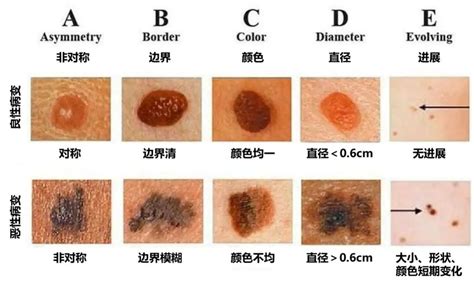 痣是凸的|为什么身上突然长出新痣？容易恶变吗？